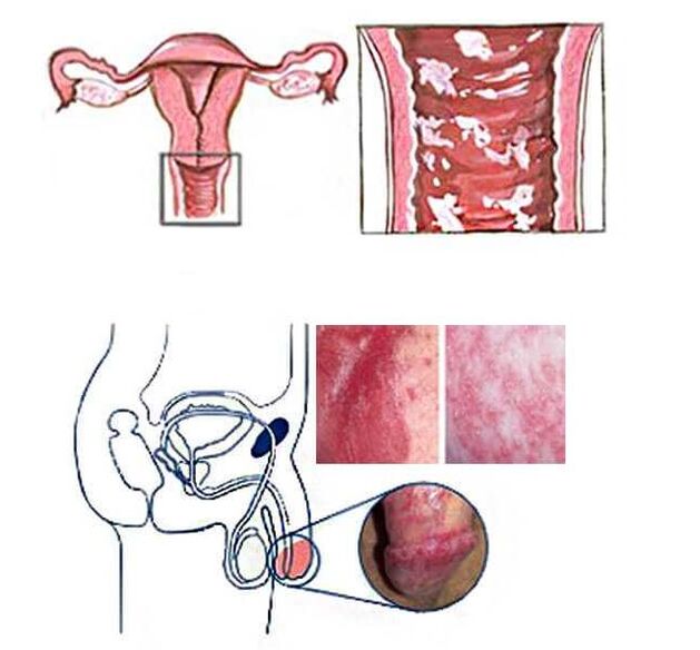 female and male genital candidiasis as a cause of pathological secretion